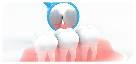 予防歯科　Prevention